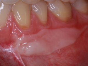 Zahnfleisch Transplantation